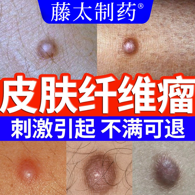 皮肤硬疙瘩纤维瘤去除搭膏药贴皮下疙瘩硬块结节痘神脂肪瘤器肿