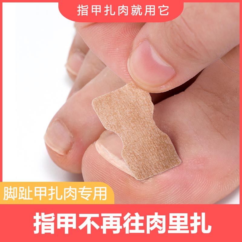 速发脚趾甲沟炎甲正器正防贴贴片嵌甲预矫神器指甲长到肉里面正甲