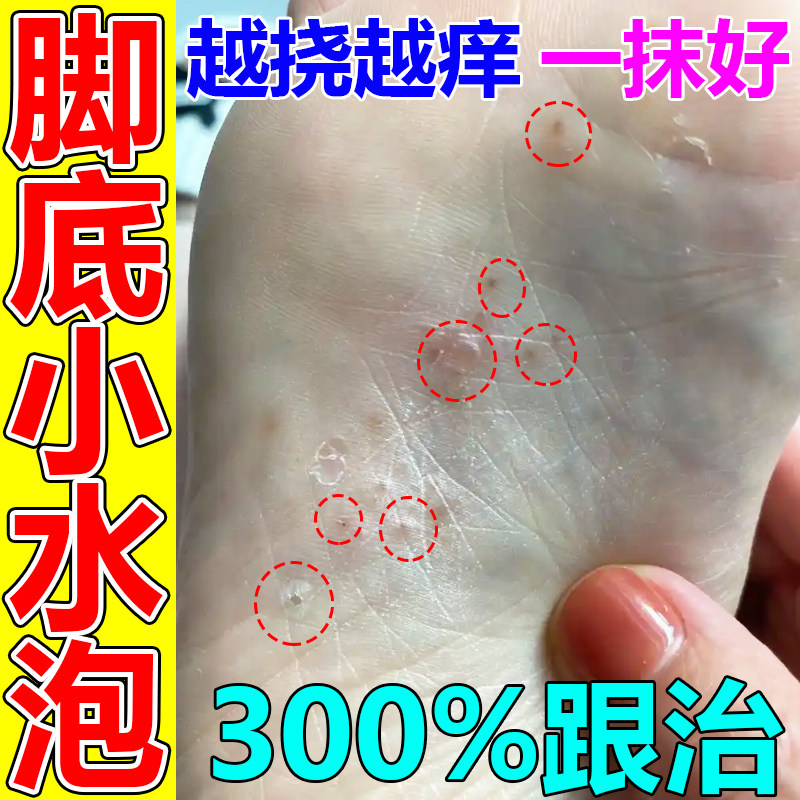 脚底上长小水泡又痒又脱皮治脚痒掉皮烂脚丫根脚止气杀菌药水疱型