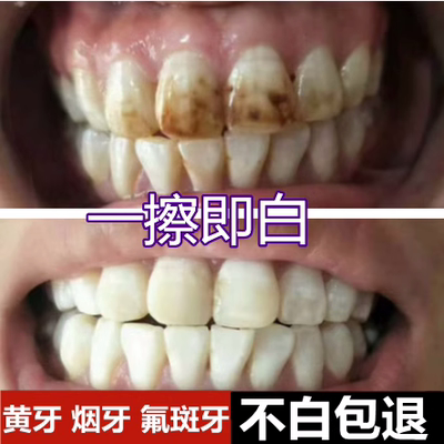 牙齿美白速效去除黄牙烟渍氟斑牙专用药水去黄洗牙液变白清洁神器