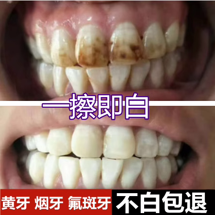牙齿美白速效去除黄牙烟渍氟斑牙专用药水去黄洗牙液变白清洁神器