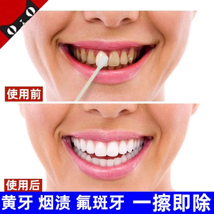 牙齿美白速效去除黄牙烟渍氟斑牙专用药水去黄洗牙液变白清洁神器
