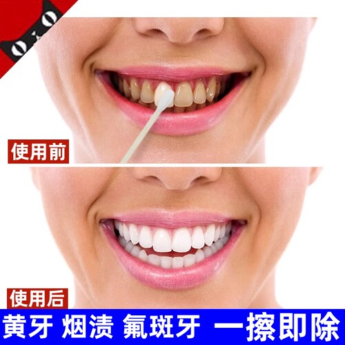 牙齿美白速效去除黄牙烟渍氟斑牙专用药水去黄洗牙液变白清洁神器