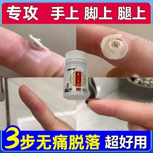 手脚上硬疙瘩去小肉粒肉刺专用膏