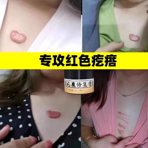 修复软化增生疤痕去瘢痕疙瘩