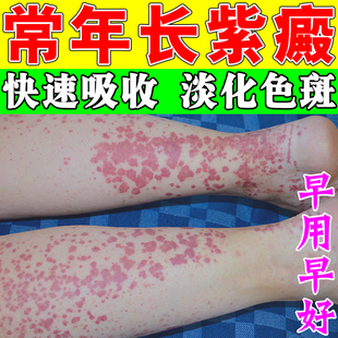 紫癜特药效过敏性皮痒治疗老年色素紫瘀斑红四肢皮下出血红点药膏