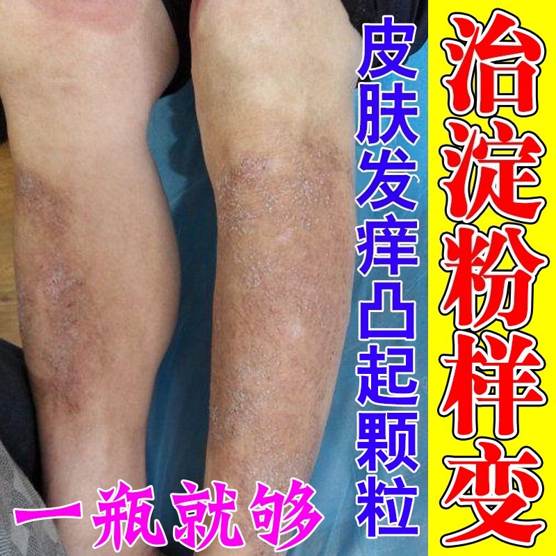 淀粉样变治疗身上顽固后背黑色素沉淀小腿胳膊皮肤粗糙小颗粒药膏