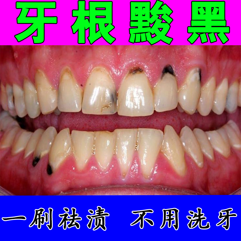 严重牙齿发黑祛黄去黑美白牙膏