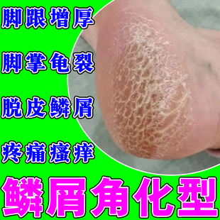 鳞屑角化型脚气角质层增厚足癣脚痒干裂脱皮去死皮杀菌止痒专用膏