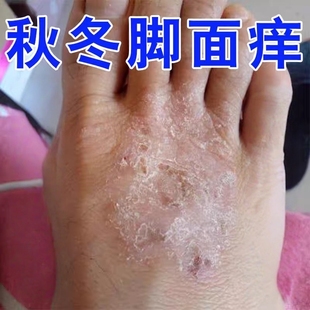 脚背发痒脚面干痒真菌感染腿脚上干燥起皮肤痒起小红点小疙瘩乳膏