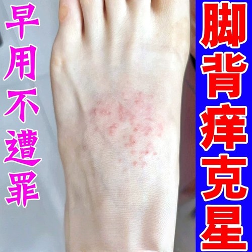 脚背痒的药专用膏脚面皮湿炎疹红疙瘩皮肤痒真菌感染长红点外用药