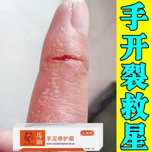 手干裂修复膏手指裂口子皮肤粗糙指头开裂流血疼痛脱皮真菌感染药