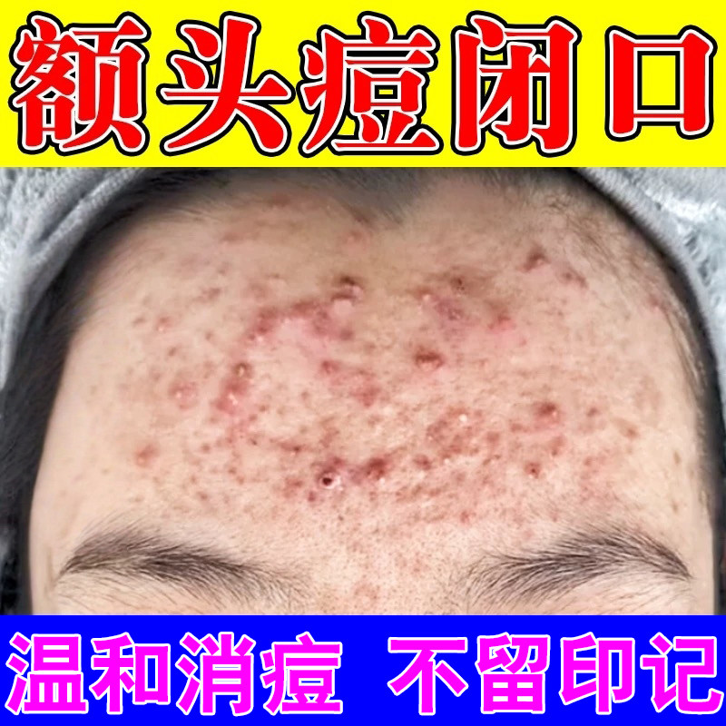 去额头青春痘痘学生青少年长闭口粉刺内调爆痘闷痘红肿硬块脓包药
