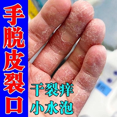 手严重脱皮专用真菌蜕皮干燥起皮修复霜换季剥脱性角质松懈症掉皮