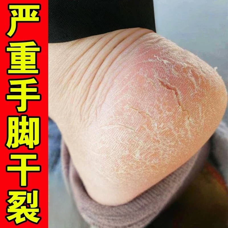 脚后跟干裂起硬皮足跟开裂治脚裂手脚脱皮修复霜鳞屑角化型抑菌膏