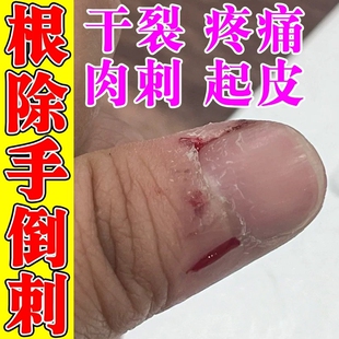 手指防倒刺营养油护理指甲边缘去死皮指头干裂脱皮长肉刺修复神器
