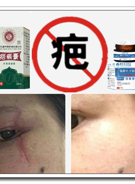 除去疙瘩增生性突起祛缝针剖宫产伤疤痕印纹身手术黑色素回流药膏