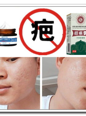 除增生修复疙瘩性突起缝针剖宫产伤疤痕印纹身手术抓伤色素沉着疤