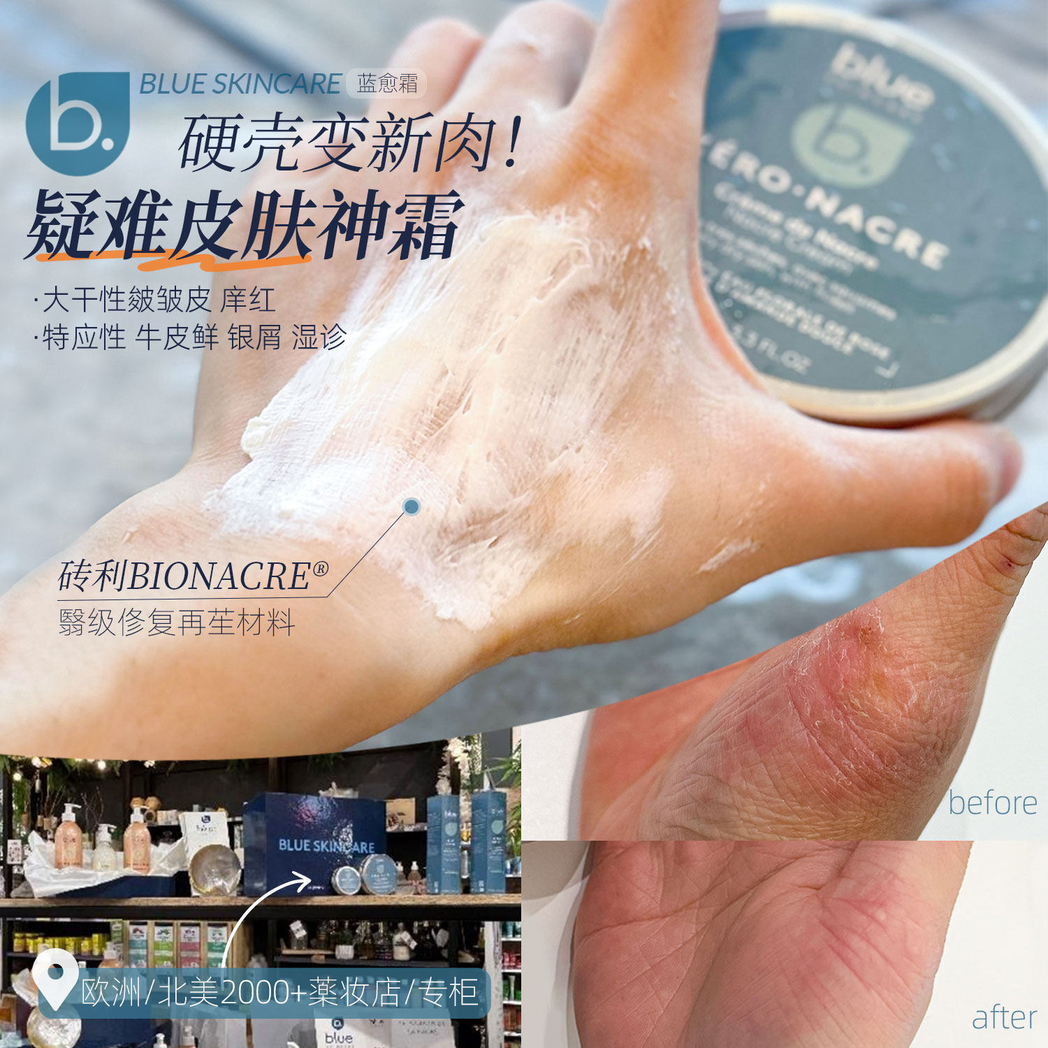 专搞问题皮肤!法国B.Blue Skincare蓝愈霜贝壳霜保湿强韧肌肤