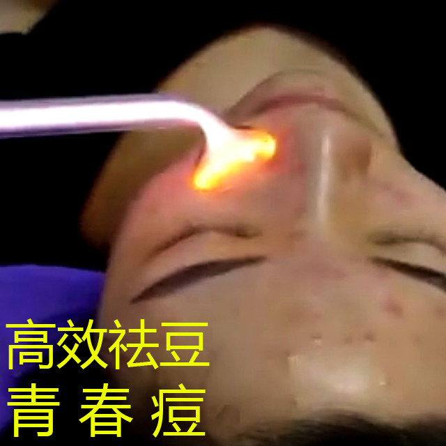 祛痘仪器高周波美容仪臭氧祛痘神器脸部除螨电疗棒杀菌去痘电疗仪