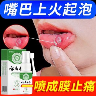 云南本草西瓜霜口腔溃疡嘴巴上火起泡烂嘴角疱疹药粉膏蜂胶喷雾剂