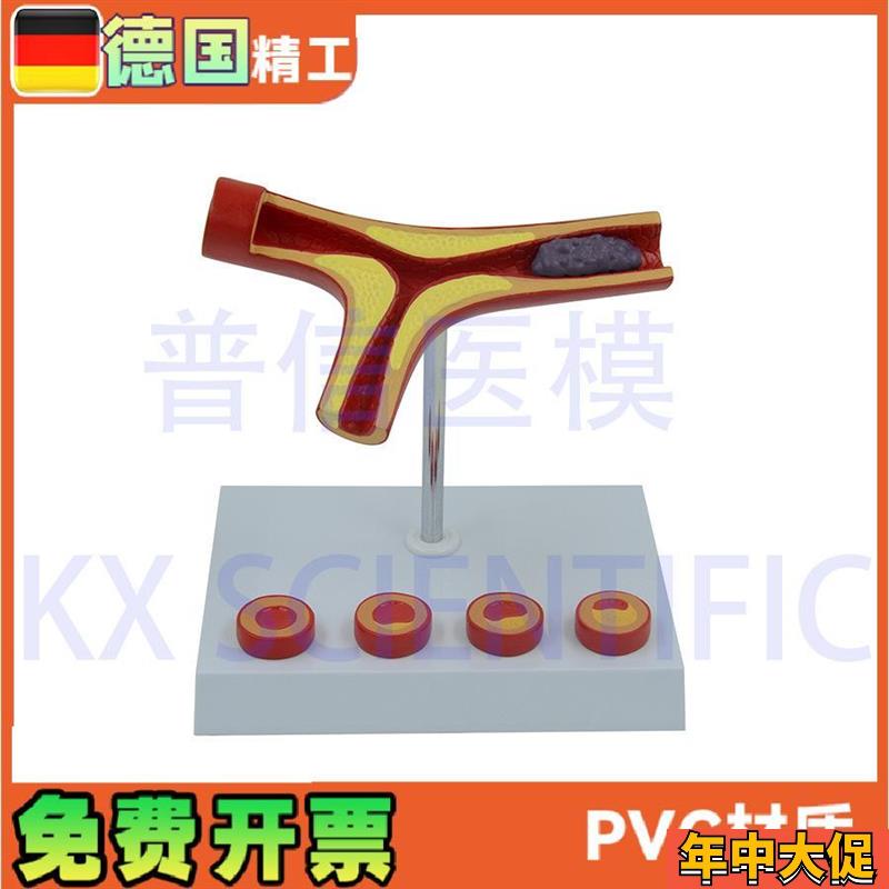 德国】动脉模型血栓冠心血管解剖教学医药礼品健康管理教具医学