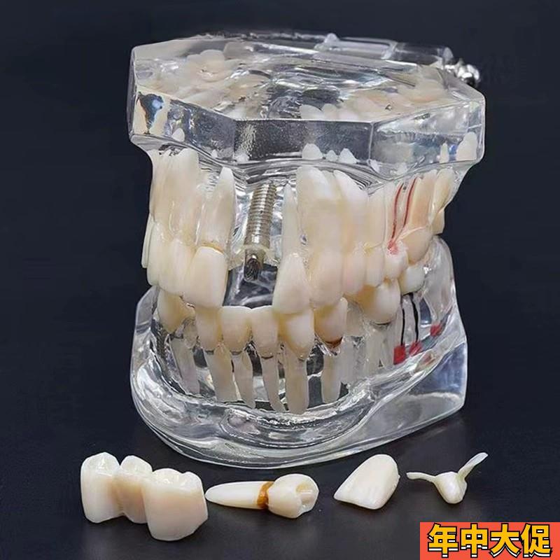 牙科材料 修复牙模型 水晶病理牙模型 活动种植牙模型 包邮