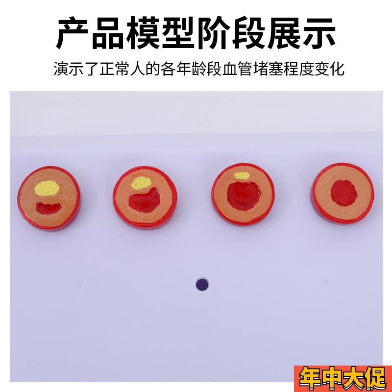 人体梗化支脉粥样心血管动脉解剖梗化模型 血管血全形成模型