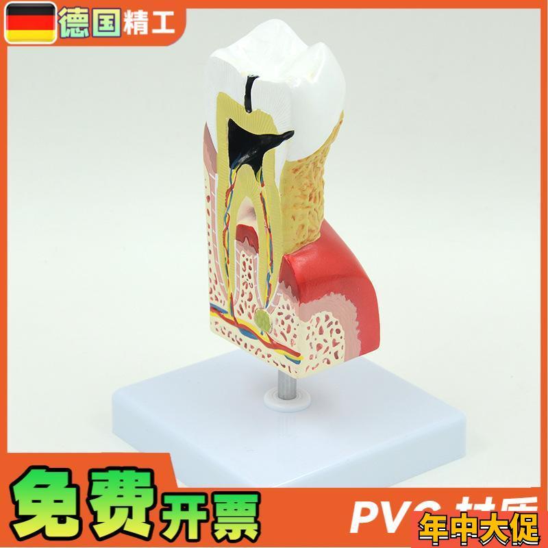 德国】人体大病理牙齿模型 蛀牙模型蛀牙放大 牙齿解剖 病理牙病