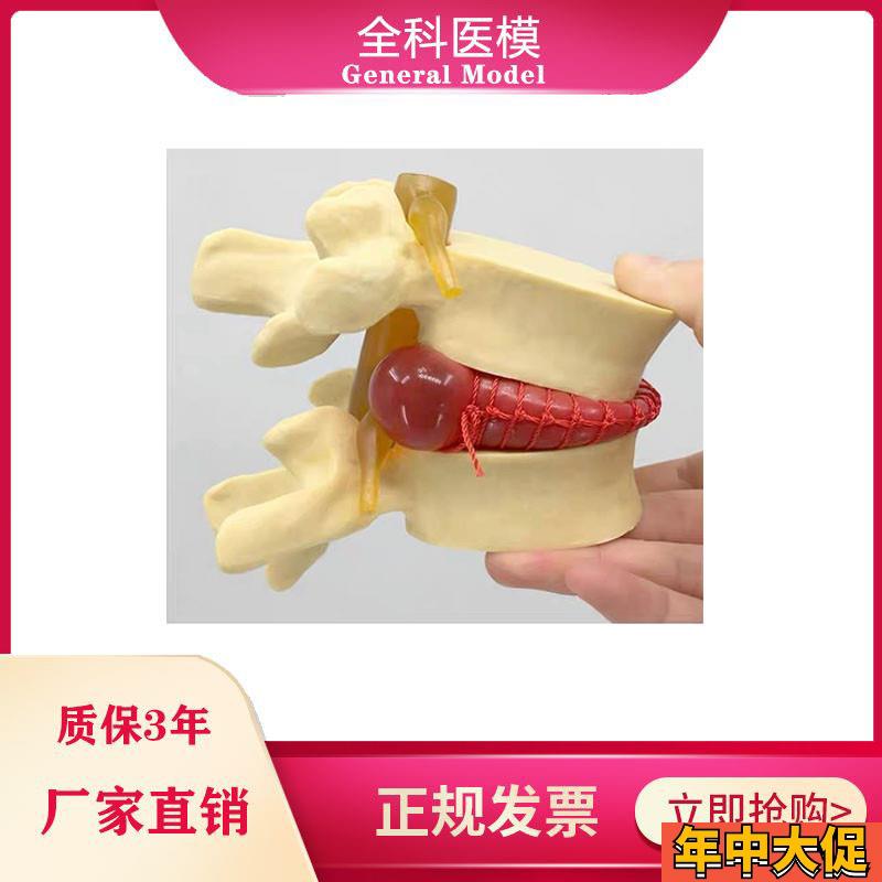 腰椎间盘突出模型