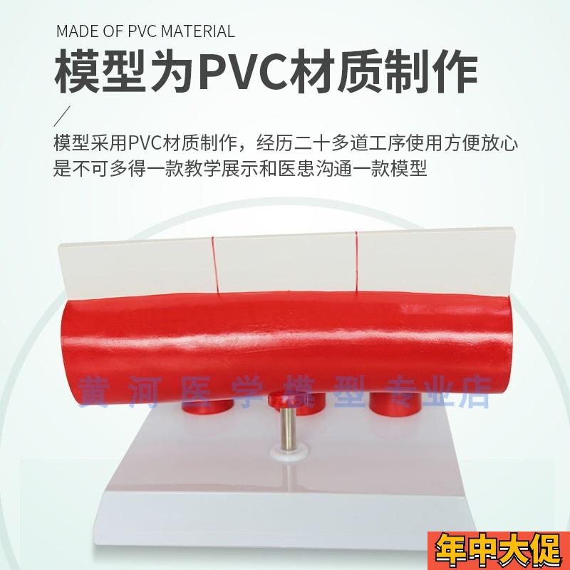 血栓模型 人体支脉粥样 硬化动脉心血管 各阶段年龄血管展示模型
