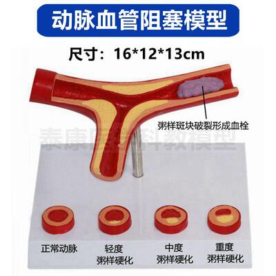 动脉血管模型脂肪斑块粥样阻塞栓子硬化血压升高内膜变化医患沟通