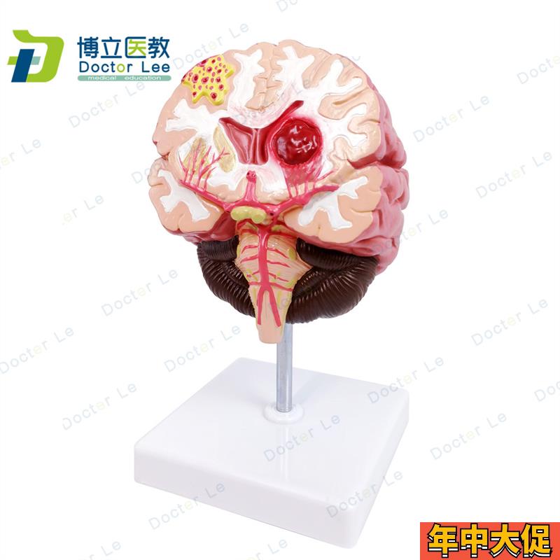 人体脑解剖 脑病理疾病 脑病理 构造 脑(血管) 病变脑模型