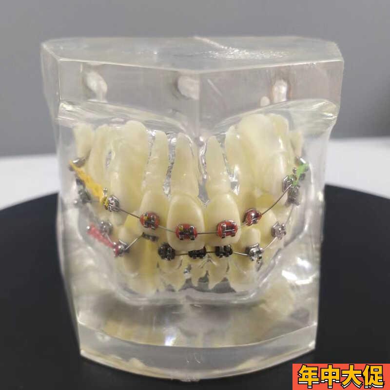 透明正畸撮合矫正模型透明水晶托槽展示结扎丝托槽正畸带支抗钉牙