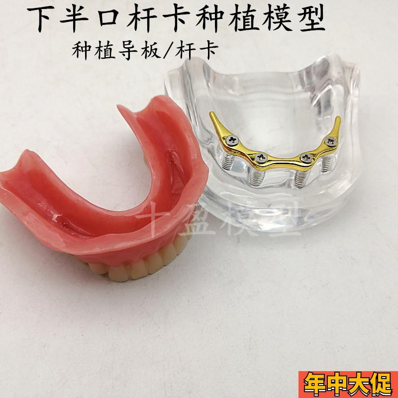 牙科模型 医患沟通 2四4颗钉 种植与修复模型种植钉球帽杆卡导板