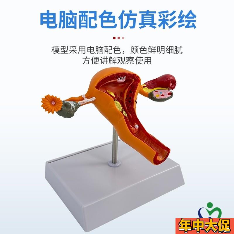 人体子宫模型女性生殖模型阴道卵巢模型教学模具病理变化科学教具