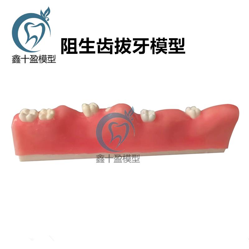 牙科阻生齿拔牙模型牙齿模型口腔教学仿真口腔护理牙医诊所牙齿病