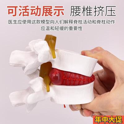 腰椎间盘突出膨出演示模型 人体脊柱脊椎病理演示关节医学教学用