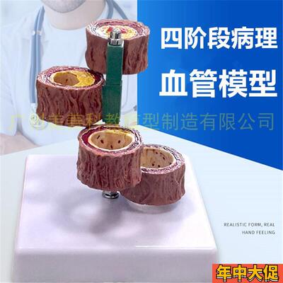 血管解剖模型 动脉粥样化 病理心血管 血液循环 血栓教学模型