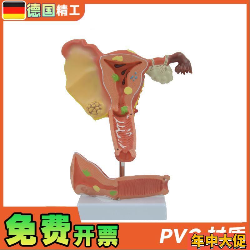 德国】PNT-0743仿真子宫模型 病理子宫输卵管结构 病态子宫模型教