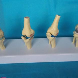 病变膝关节比较m模型骨骼骨架模型医用人体标本模