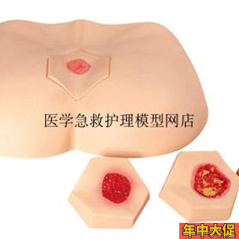 阶段褥疮护理模型  护理操作不同阶段四个临床分期成人臀部