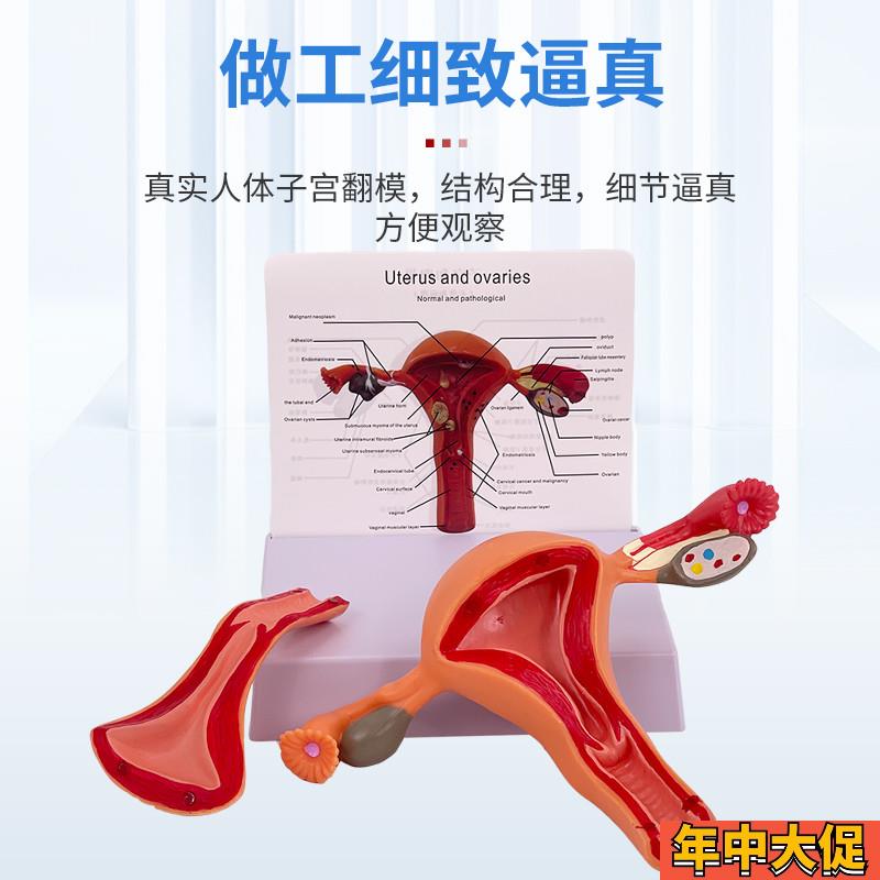 病理子宫模型 病变子宫解剖卵巢模型妇科教具 医学人体女性生殖器