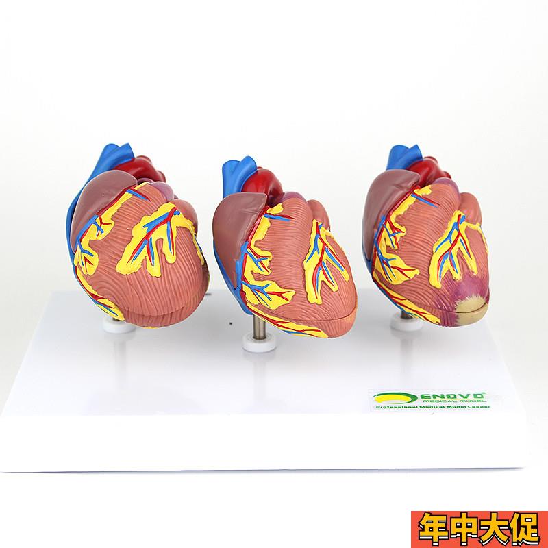 ENOVO颐诺 心脏病演示模型心血管系统 心肌梗死 充血性心力衰竭心