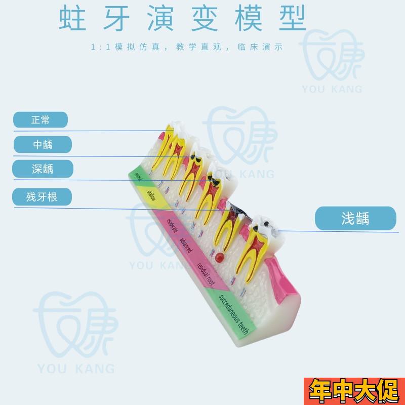 口腔教学模型 牙科口腔 牙科蛀牙模型 蛀牙演示模型 蛀牙龋齿模型