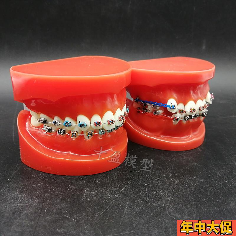 口腔牙列整齐正畸模型红牙列不齐错颌缺失牙齿仿真牵引皮链支抗钉