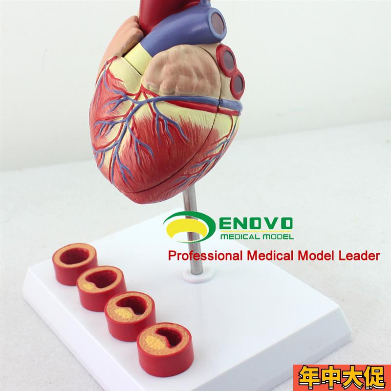 ENOVO颐诺 1:1医学人体心脏模型冠状动脉血栓心内科教学动脉粥样