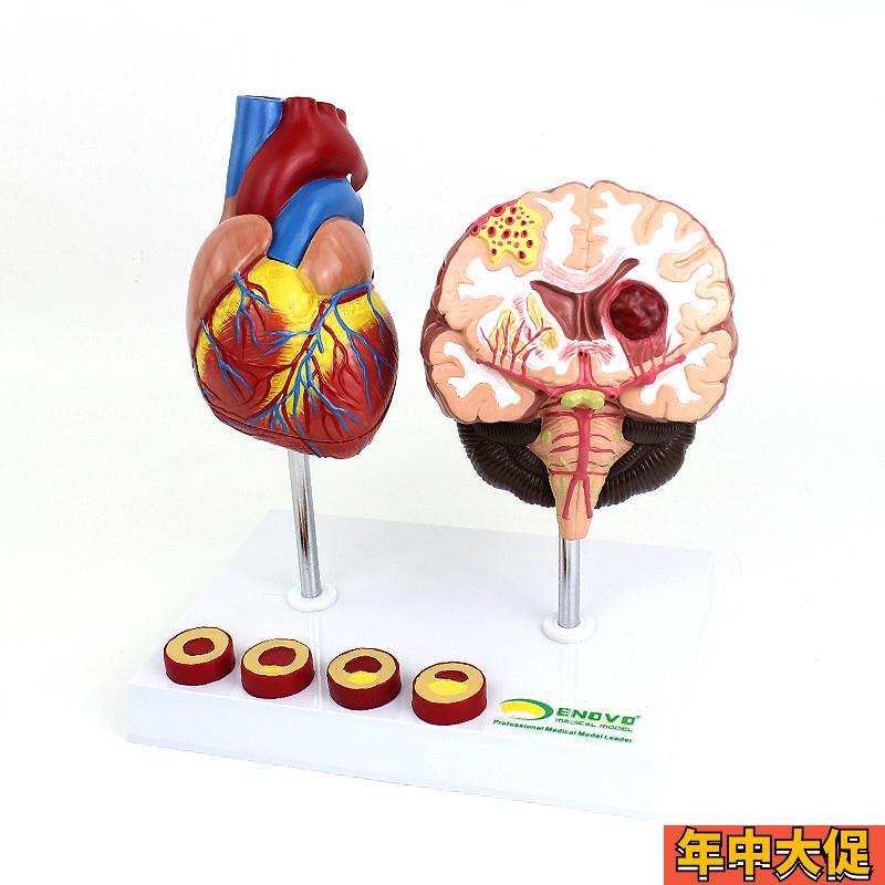 ENOVO颐诺 心脑血管疾病展示模型 高血压心脏 心血管疾病模型 脑