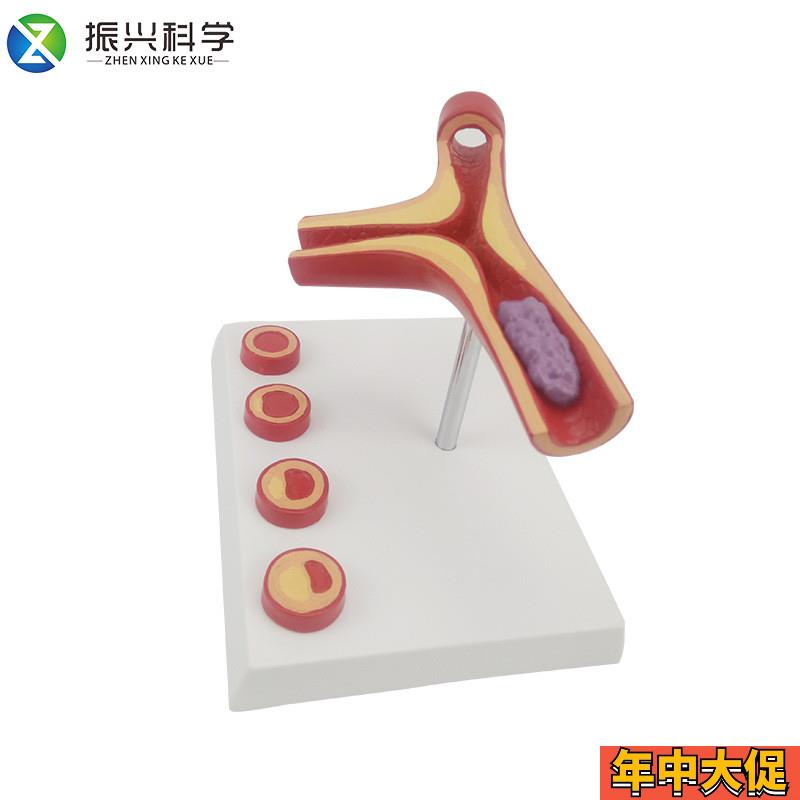德国】Y型动脉模型硬化带血栓模型人体血管医学教学模具