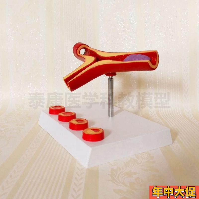 动脉血管模型脂肪斑块粥样阻塞栓子硬化血压升高内膜变化医患沟通